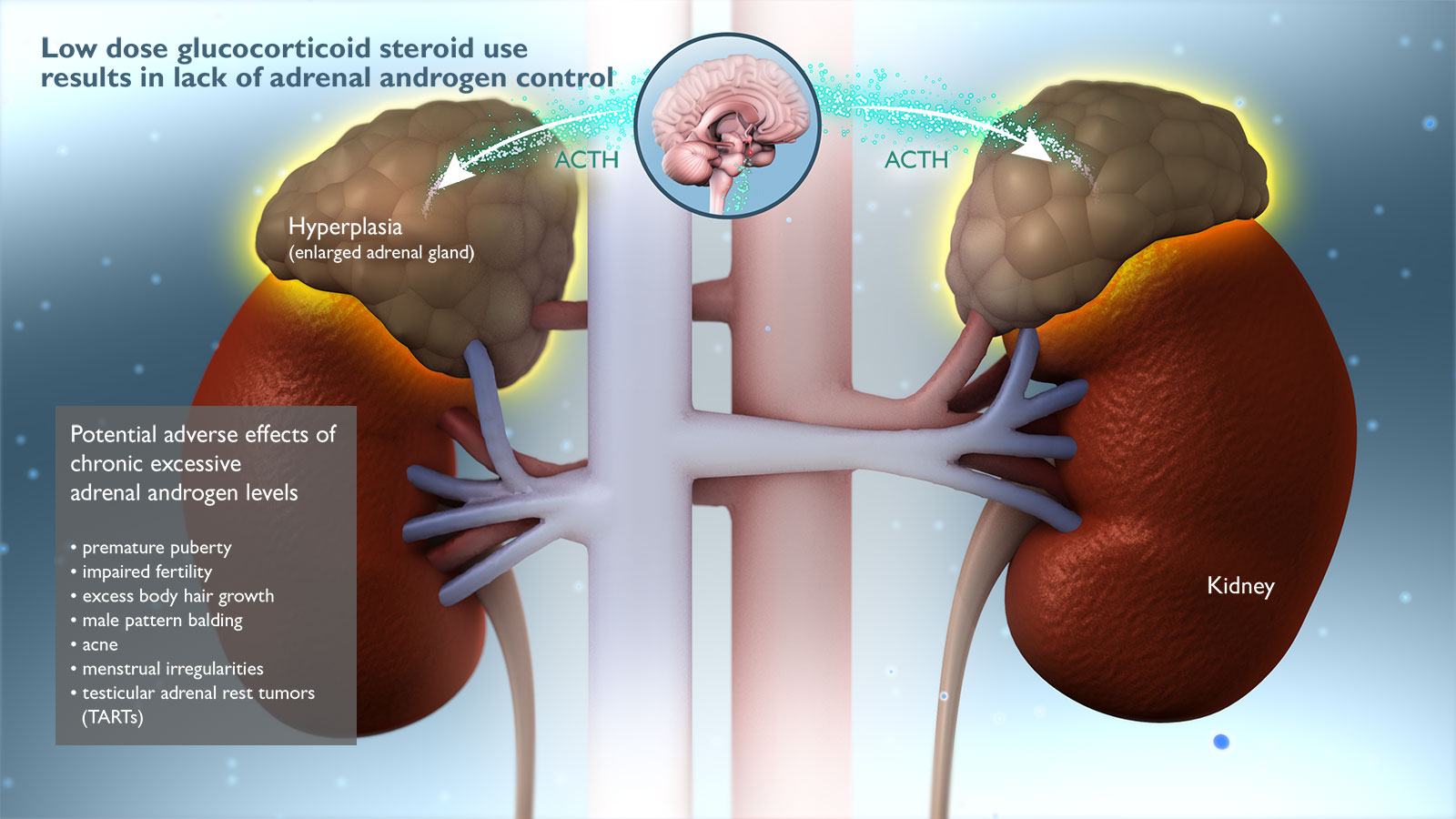 Replacement Glucocorticoid Steroids and Excessive Adrenal Androgens diagram